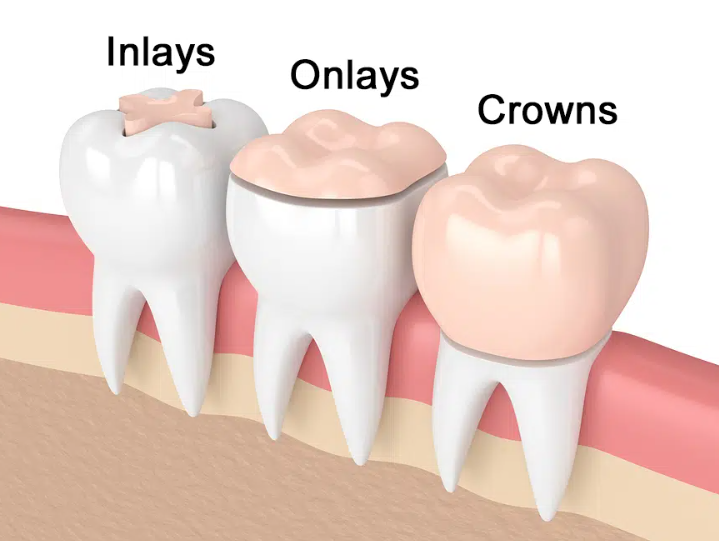 인레이-온레이-차이점