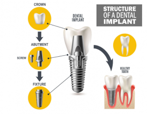 임플란트 구조 1