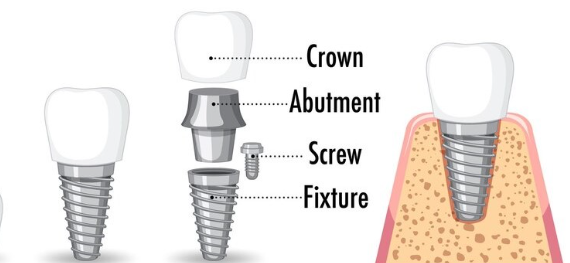 임플란트 구조 3