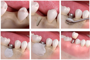 임플란트-뼈이식-수술