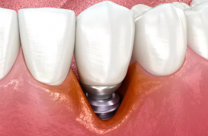 임플란트-주위염-염증 (2)