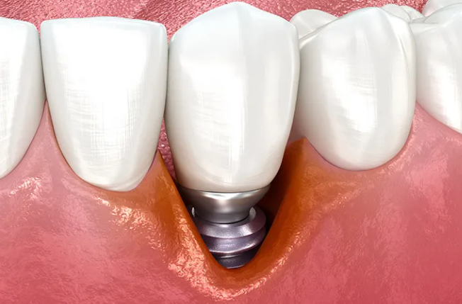 임플란트-주위염-염증 (2)