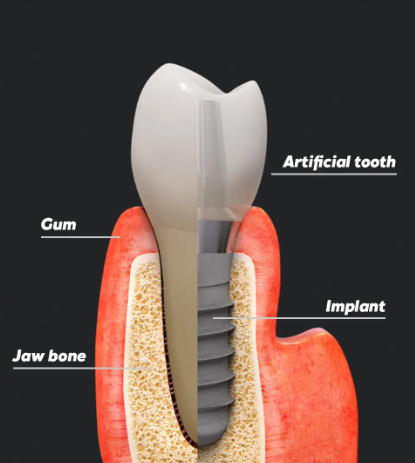 임플란트-치조골이식수술 (2)