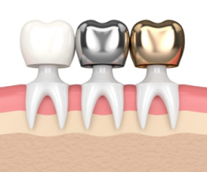 치아 크라운 종류