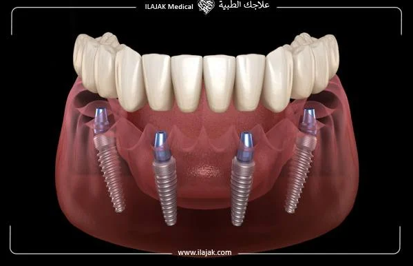 전체-임플란트-ALL-ON-4