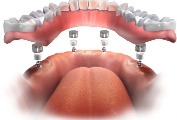 전체-임플란트-오버덴처