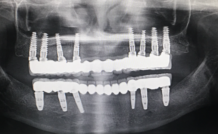 전체-임플란트-풀마우스